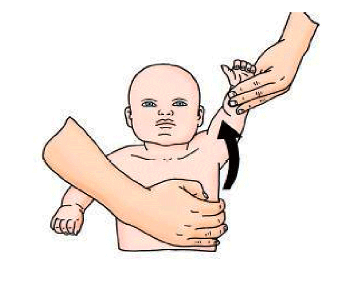 تمرینات کاردرمانی برای فلج ارب در منزل